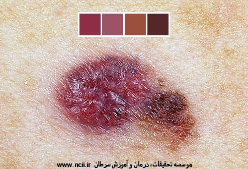 ABCDE مربوط به خال را یاد بگیرید: 