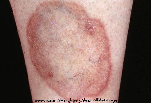 پلاک لبه قرمز دارای مرکز طلایی رنگ بر روی ساق پا