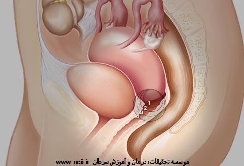 مراحل سرطان گردن رحم