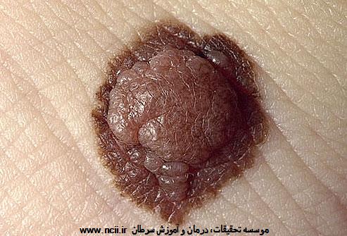 ABCDE مربوط به خال را یاد بگیرید: 