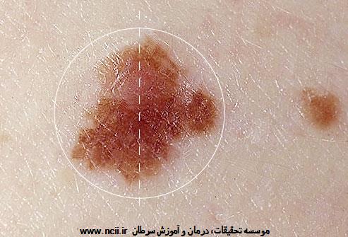 ABCDE مربوط به خال را یاد بگیرید: 