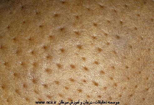 نشانه‌های سرطان التهابی پستان