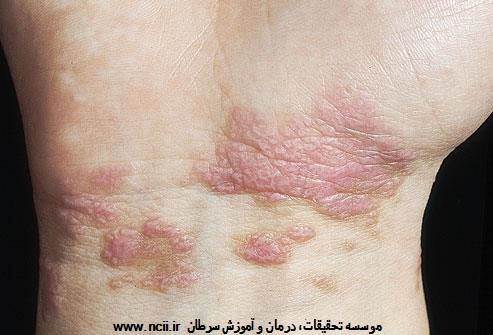 ورم‌های خارش‌دار بنفش رنگ بر روی مچ دست