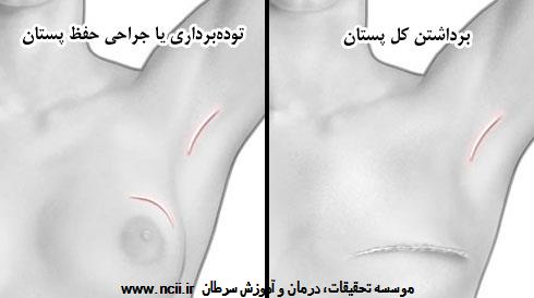 جراحی سرطان پستان