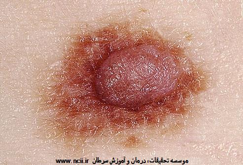 ABCDE مربوط به خال را یاد بگیرید: 