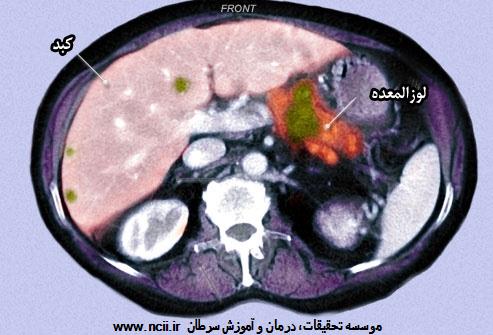  تشخیص سرطان لوزالمعده