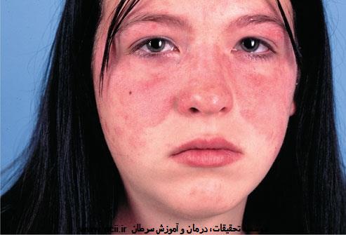 جوش پروانه‌ای( butterfly rash)