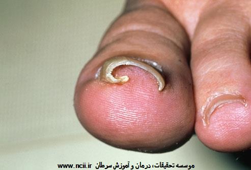 رشد ناخن انگشت پا به داخل گوشت 