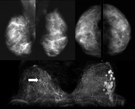 سونوگرافی و MRI (ام آرآی) پستان
