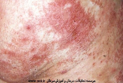جوش پوسته‌دار روی کپل، قرمز شدن زبان