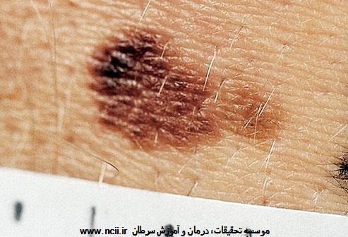 ABCDE مربوط به خال را یاد بگیرید: